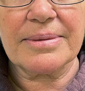After Image: Cynosure Laser