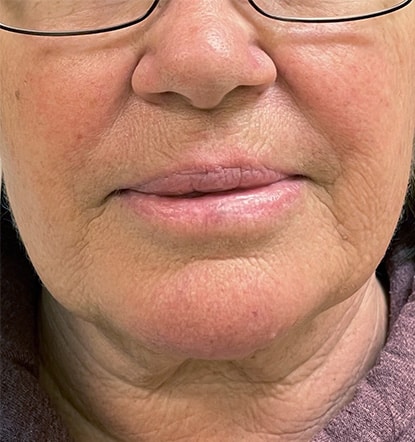 After Image: Cynosure Laser - front