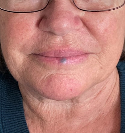 Before Image: Cynosure Laser - front