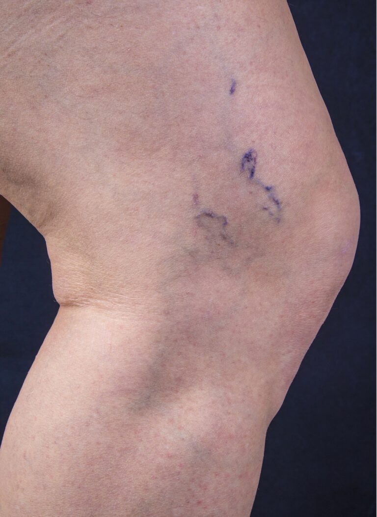 Before Image: Spider Veins - other