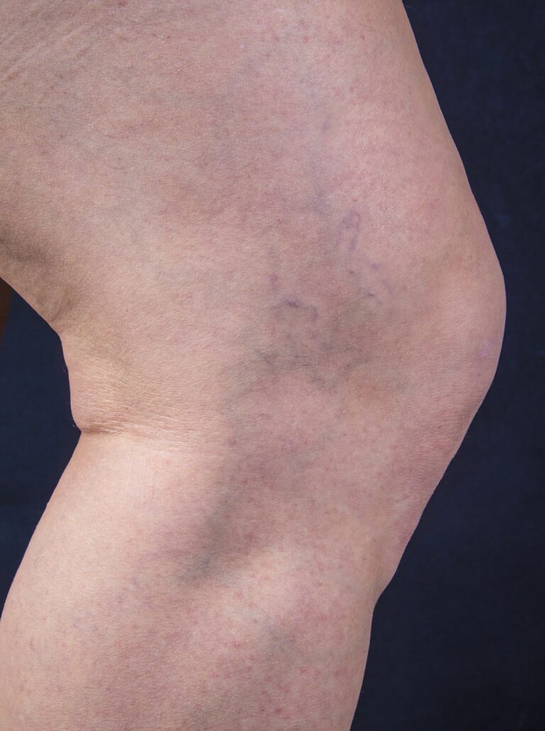 After Image: Spider Veins - other