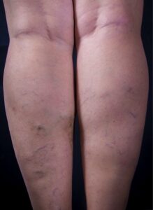 Before Image: Varicose Veins