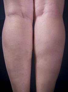 After Image: Varicose Veins