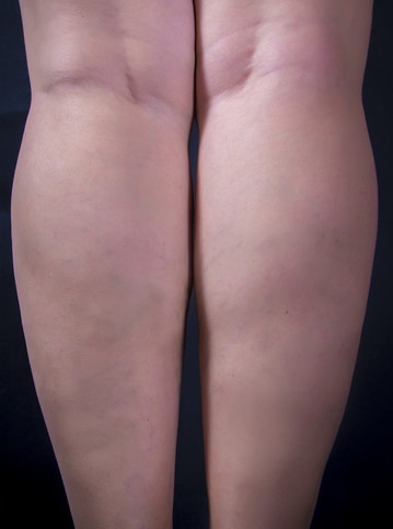 After Image: Varicose Veins - back