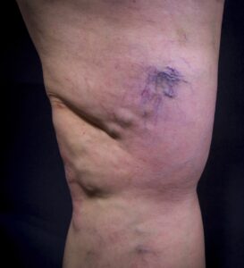 Before Image: Varicose Veins