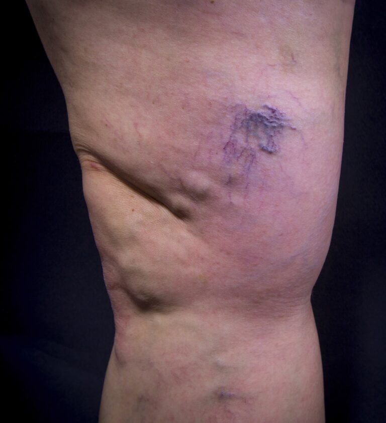 Before Image: Varicose Veins - front