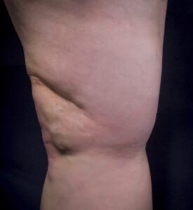 After Image: Varicose Veins