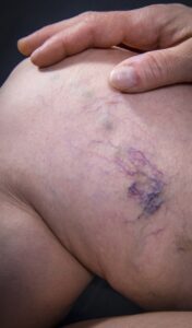 Before Image: Spider Veins