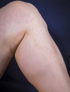 After Image: Varicose Veins