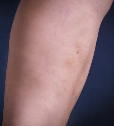 After Image: Varicose Veins - front