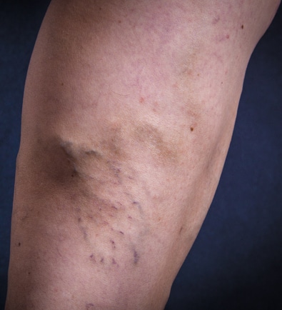 Before Image: Varicose Veins - front