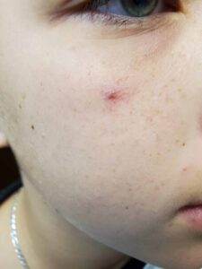 After Image: Cynosure Laser