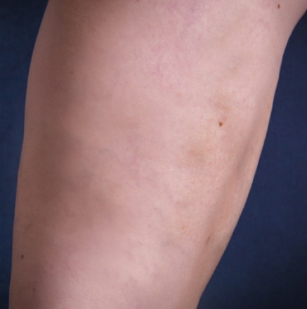 Varicose Veins