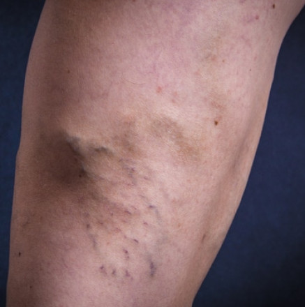 Varicose Veins