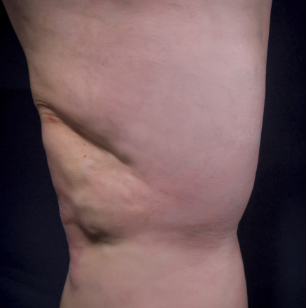 Varicose Veins