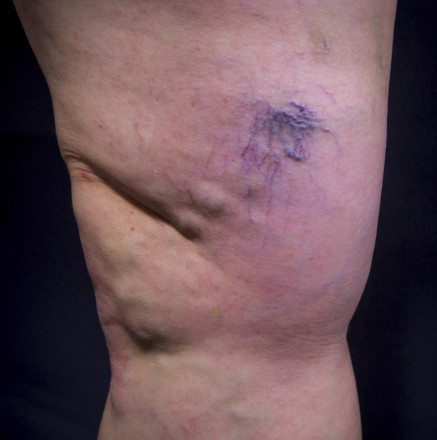 Varicose Veins