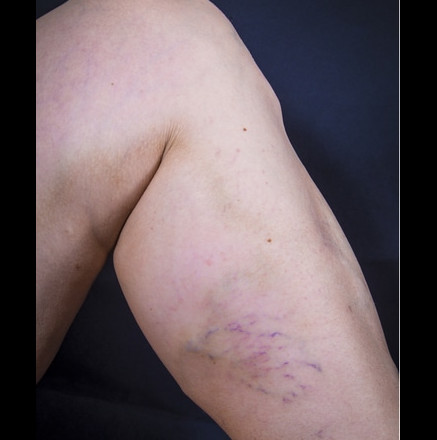 Varicose Veins