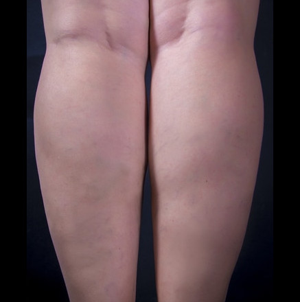 Varicose Veins